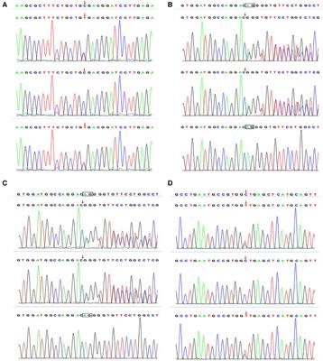 Case report: Diagnosis and treatment of DGAT1 deficiency-induced congenital diarrhea in two cases and literature review